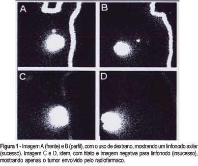 Lymphoscintigraphy imaging study for sentinel node mapping, comparing dextran 500 with phytate, in breast cancer patients