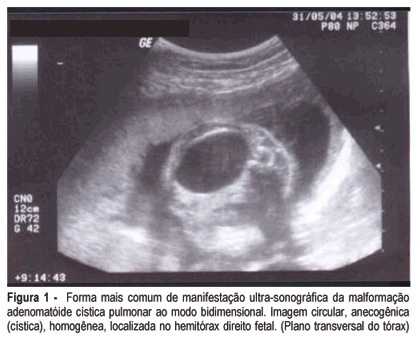 Prenatal diagnosis and therapy for fetal cystic adenomatoid pulmonary malformation: a case report