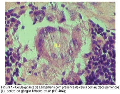 Coexistence of axillary tuberculous lymphadenitis and ganglionic metastasis in mammary lobular carcinoma: a case report