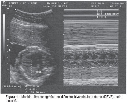Cardiofemoral index for the evaluation of fetal anemia in isoimmunized pregnancies