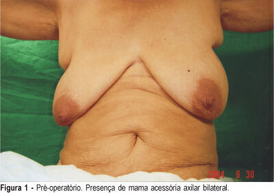 Sentinel lymph node in accessory breast cancer: a case report