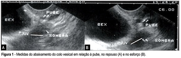 Evaluation of ultrasound parameters used as a diagnostic method for stress urinary incontinence
