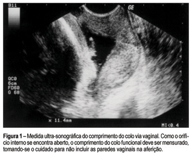 Transvaginal ultrasound of the cervix for predicting premature delivery in symptomatic patients with intact membranes