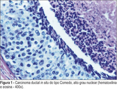 Approach of ductal carcinoma in situ of the breast in three public hospitals in Belo Horizonte