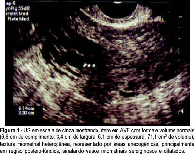 Uterine arteriovenous malformation after gestational trophoblastic disease