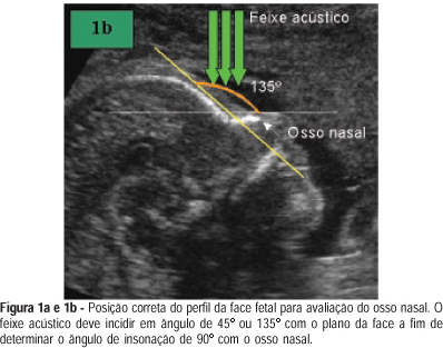 Ultrasonographic assessment of fetal nasal bone: normal ranges throughout gestation