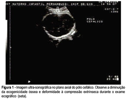 Prenatal diagnosis and vaginal delivery in osteogenesis imperfecta: a case report