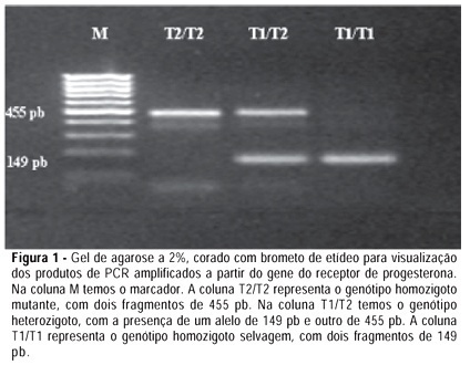 Relation between progesterone receptor gene polymorphism, race, parity, and uterine leiomyoma occurrence
