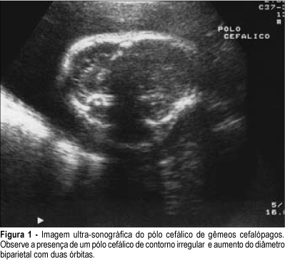 Prenatal diagnosis of conjoined twins by magnetic resonance imaging: report of two cases