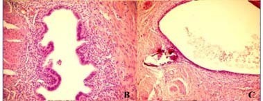 Evaluation of the endometriosis histological classification observed in specimens of women affected by superficial and deeply infiltrating pelvic endometriosis