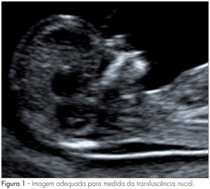 First-trimester screening for chromosomal abnormalities
