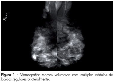 Multiple bilateral fibroadenomas after kidney transplantation and immunossuppression with cyclosporine A