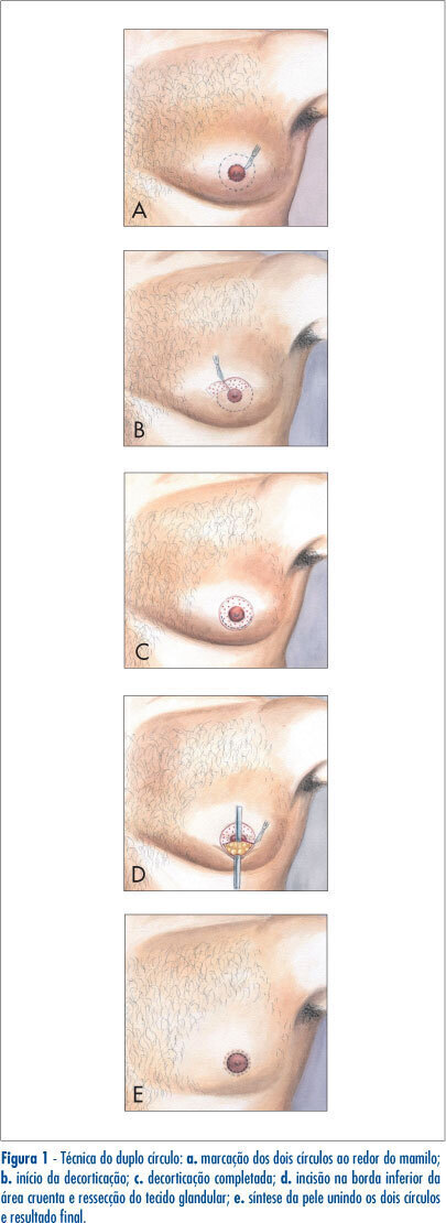 Comparative analysis of the double-circle incision and techniques with periareolar and transareolopapilar incision for the surgical correction of gynecomastia