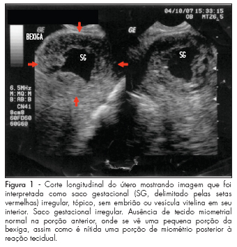 Cesarean scar ectopic pregnancy: a case report