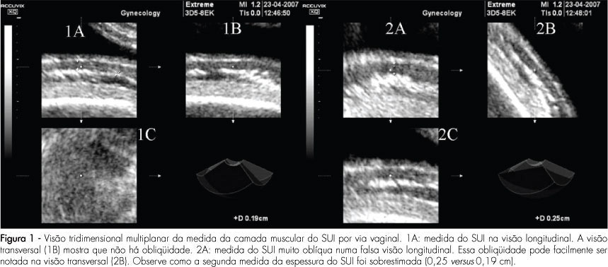 Lower uterine segment thickness measurement in pregnant women with previous caesarean section: intra- and interobserver reliability analysis using bi- and tridimensional ultrasonography