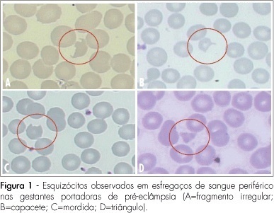Ming of the presence of schistocytes in blood smear of preeclamptic pregnat women