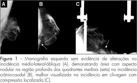 Sternalis muscle simulating a breast nodule