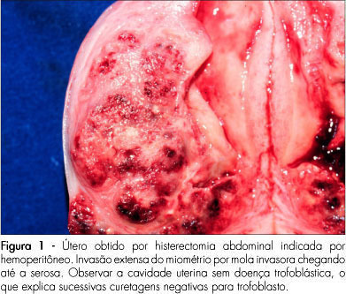 Hydatidiform mole and gestational trophoblastic disease