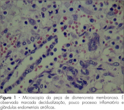 Membranous dysmenorrhea: a forgotten disease