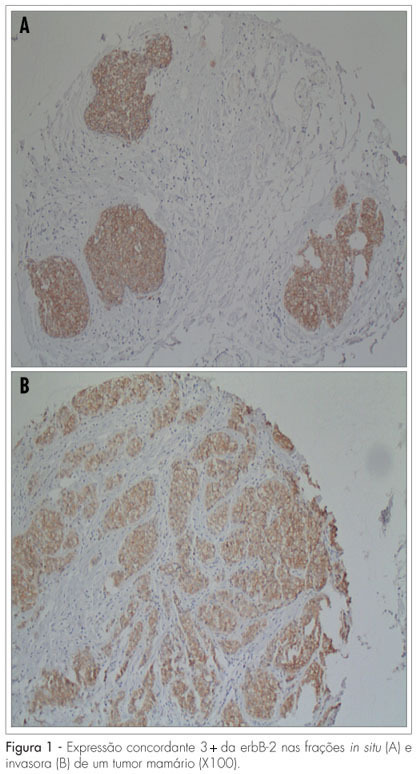 ErbB-2 expression and hormone receptor status in areas of transition from in situ to invasive ductal breast carcinoma