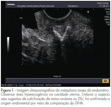 Endometrial osseous metaplasia: clinical presentation and follow-up
