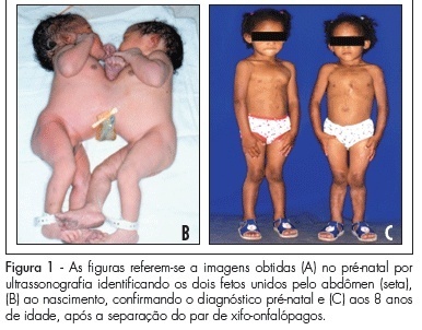 Conjoined twins: an experience of a tertiary hospital in Southeast Brazil
