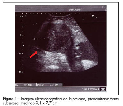 Myomectomy in the second trimester of pregnancy: case report