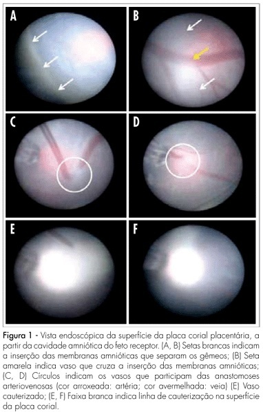 Laser ablation of placental vessels for treatment of severe twin-twin transfusion syndrome: experience from an university center in Brazil