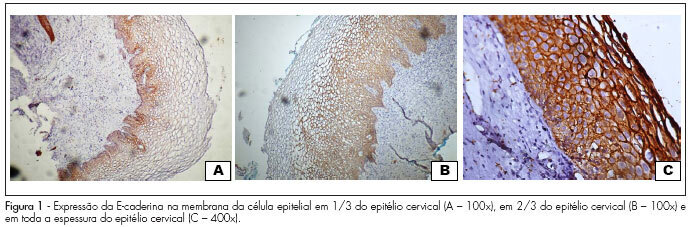 Is there any change in the cell adhesion method mediated by e-cadherin in cervical neoplasia of HIV-infected patients?