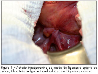 A borderline ovarian tumor in inguinal canal: case report