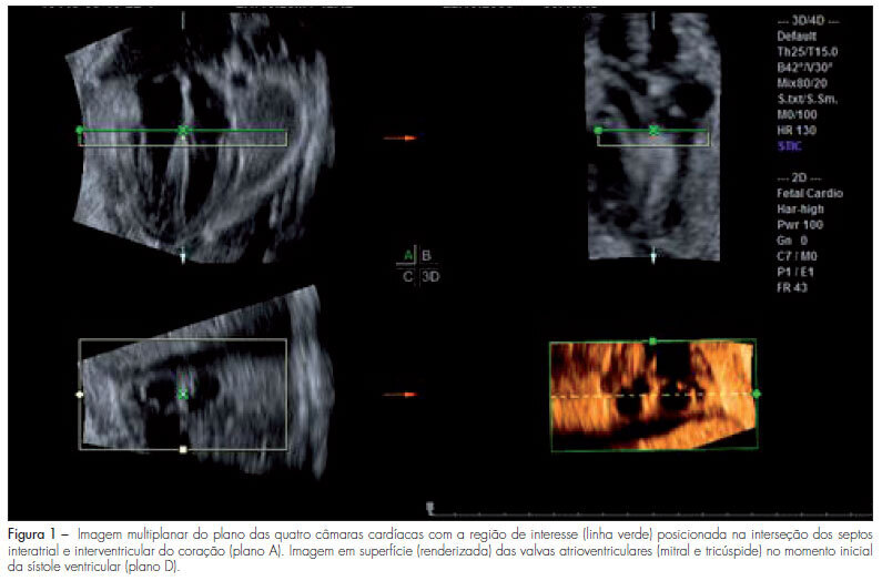 Assessment of the fetal mitral and tricuspid valves areas development by three-dimensional ultrasonography