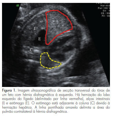 Tracheal occlusion for fetuses with severe isolated left-sided diaphragmatic hernia: a nonrandomized controlled experimental study
