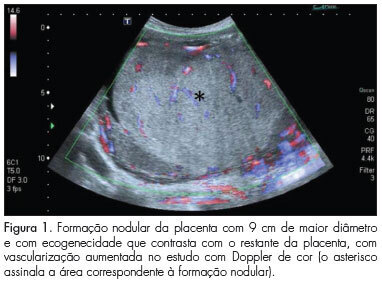 Placental vascular lesion as cause of IUGR and nonimmune fetal hydrops in twin pregnanc
