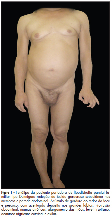 Dunnigan-type familial partial lipodystrophy: attention to precocious diagnosis