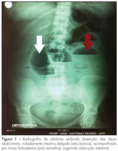Inflammatory bowel disease – Crohn’s disease and pregnancy: case report