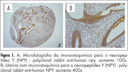 Expression of neurotrophic and inflammatory mediators in rectosigmoid endometriosis