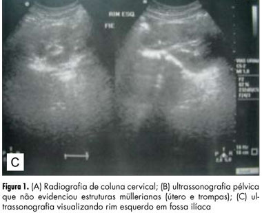 Atipical form of Mayer-Rokitansky-Kuster-Hauser syndrome with renal malformation and skeletal abnormalities (MURCS association)