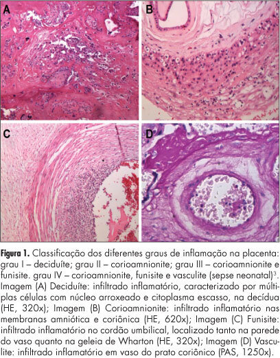 Influence of maternal and fetal intercurrences on the different degrees of chorioamnionitis
