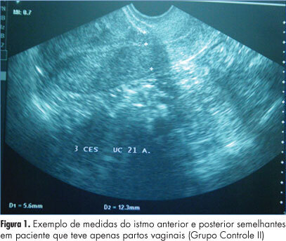 Ultrasound evaluation of uterine scar after segmental transverse cesarean surgery