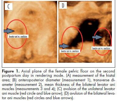 Assessment of pelvic floor by three-dimensional-ultrasound in primiparous women according to delivery mode: initial experience from a single reference service in Brazil