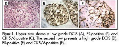 Comparison of nuclear grade and immunohistochemical features in situ and invasive components of ductal carcinoma of breast
