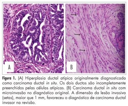 Consultation in breast surgical pathology: interobserver diagnostic variability of atypical intraductal proliferative lesions