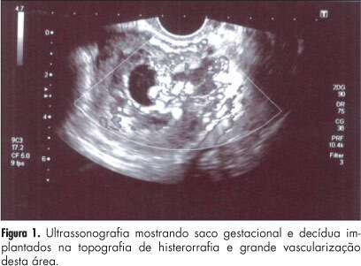 Conservative management of ectopic pregnancy in cesarean scar: case report
