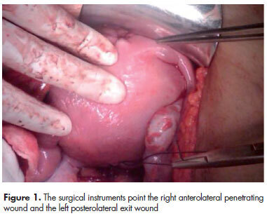 Gunshot wound to the pregnant uterus: case report