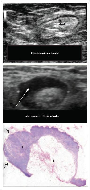 Axillary lymph node aspiration guided by ultrasound is effective as a method of predicting lymph node involvement in patients with breast cancer?