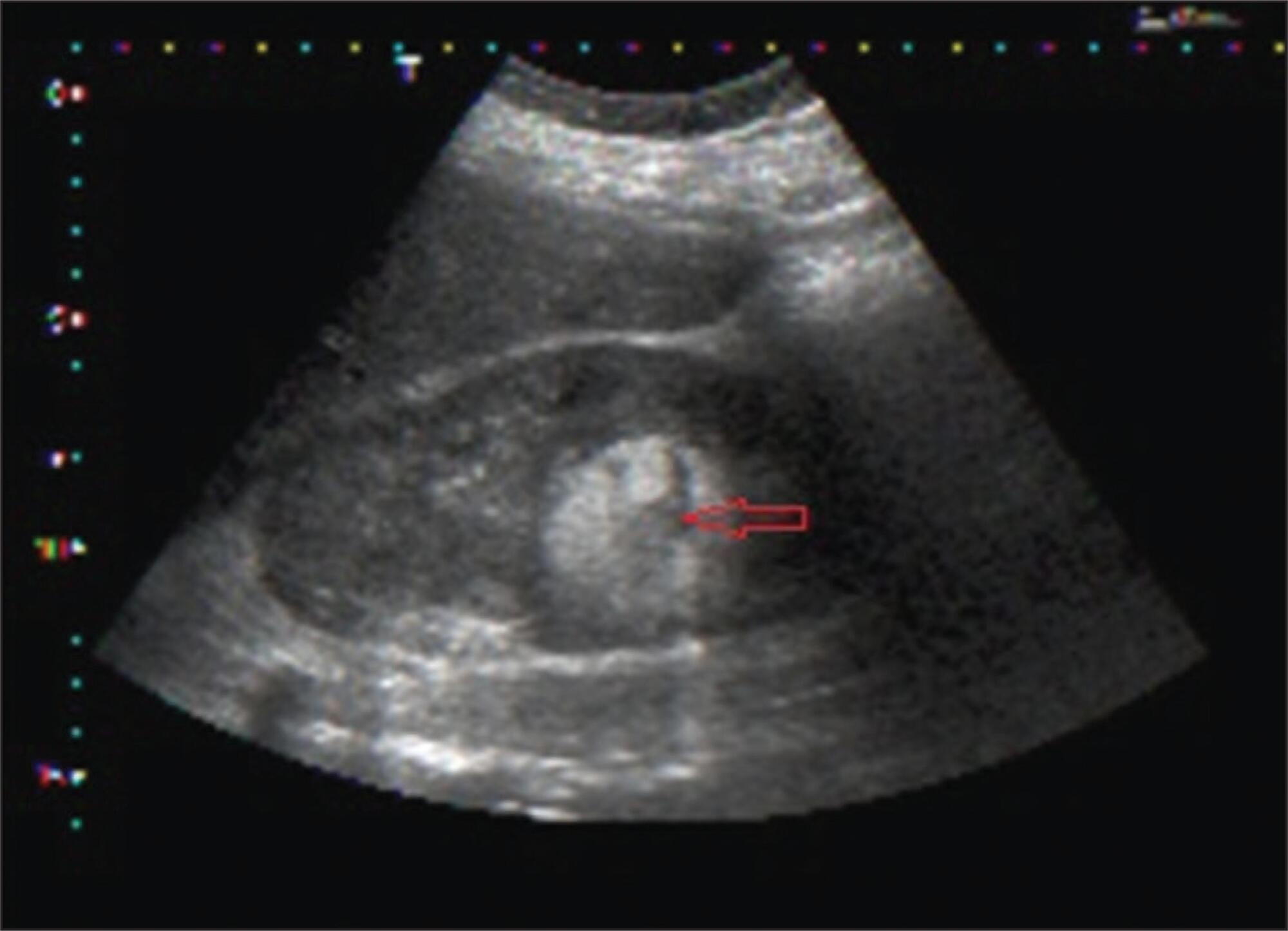 Spontaneous rupture of renal angiomyolipoma during pregnancy