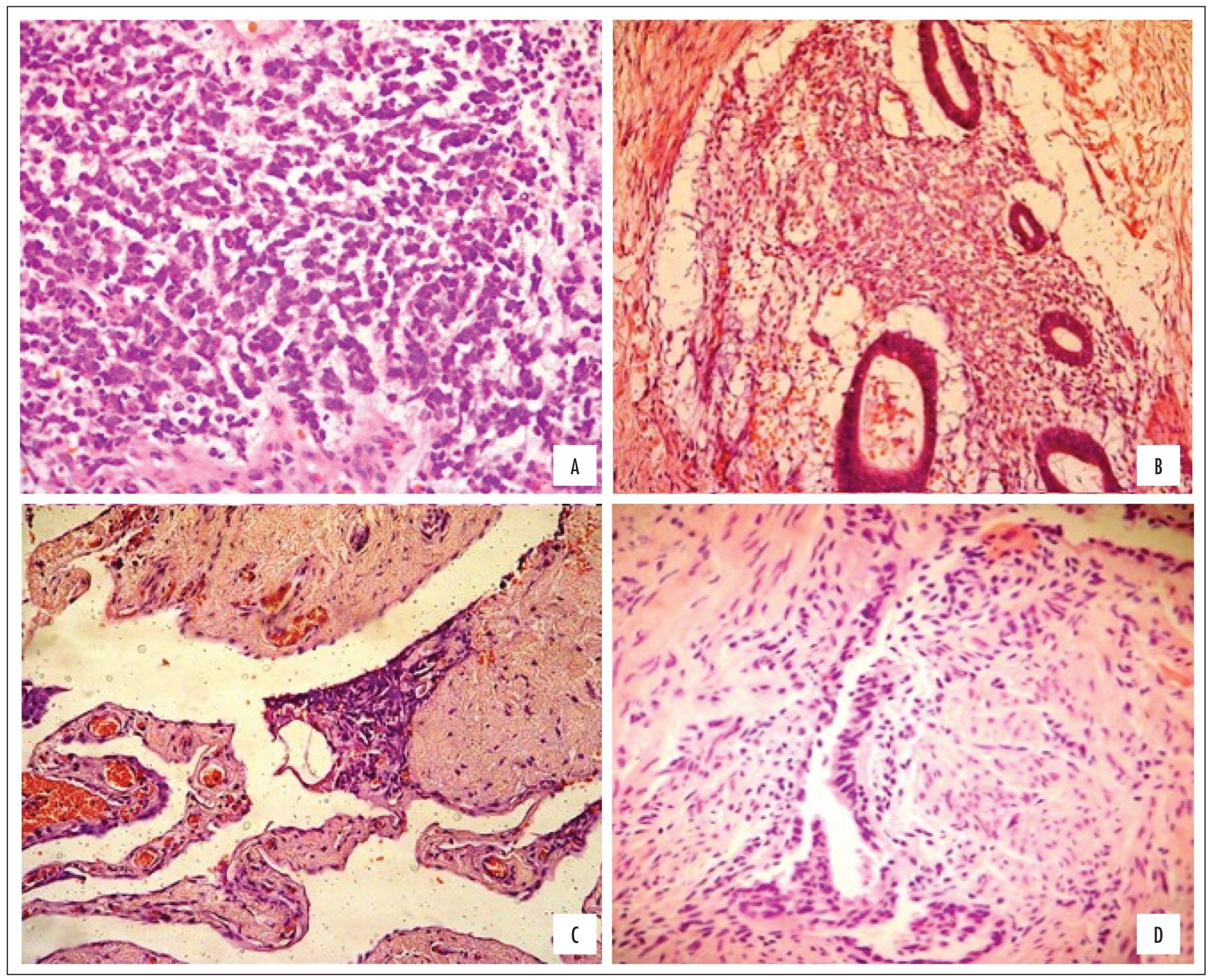 Histological classification and quality of life in women with endometriosis