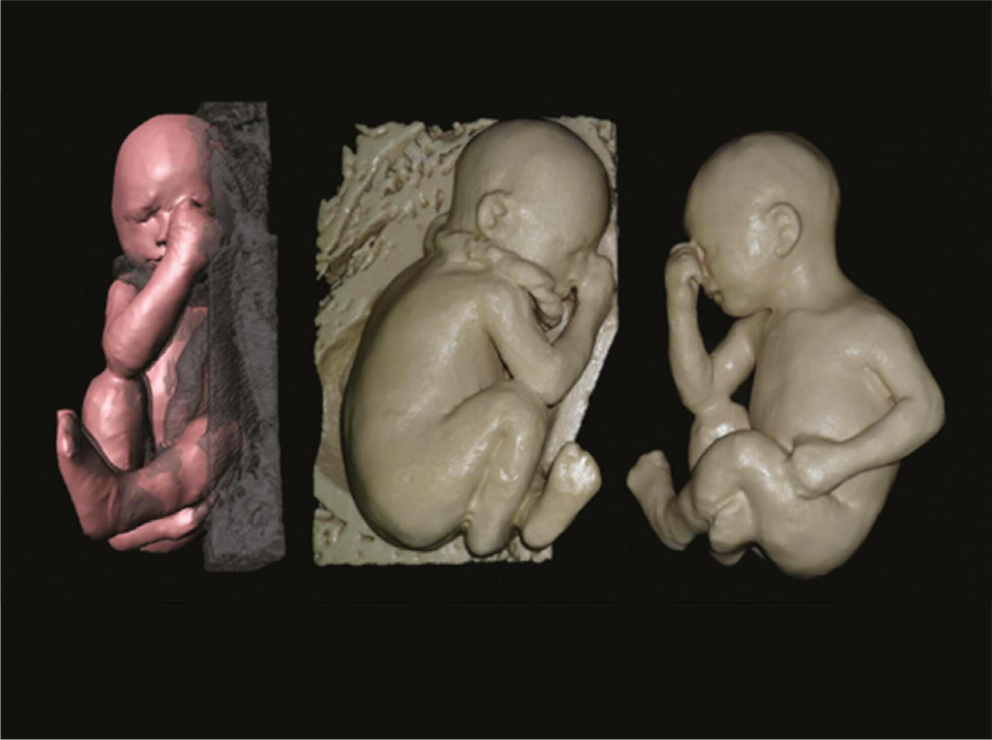 Physical models of the foetus created using magnetic resonance imaging, computed tomography, and ultrasound data: history, description, and potential uses
