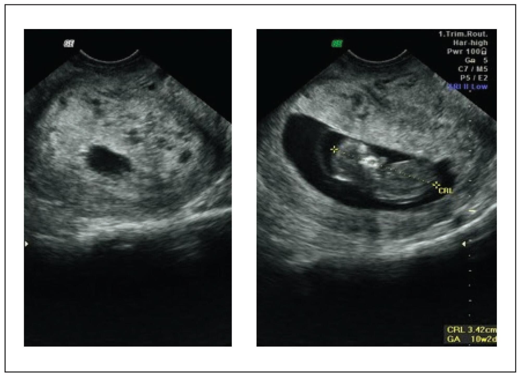 Gestational trophoblastic neoplasia after spontaneous normalization of human chorionic gonadotropin in patient with partial hydatidiform mole