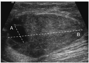 Cysts within Otherwise Probably Benign Solid Breast Masses and the Risk of Malignancy